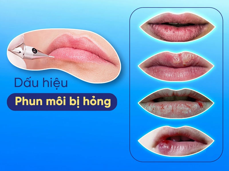 Nhận Biết Dấu Hiệu Phun Môi Bị Hỏng, Nhiễm Trùng & Hướng Xử Lý An Toàn, Chuẩn Y Khoa