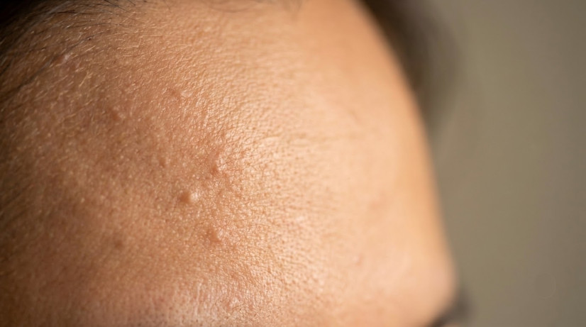 Da mặt bị mụn ẩn dưới da cần lấy mụn ẩn đúng cách