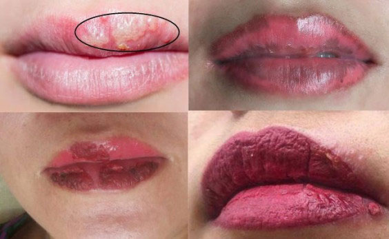 Những dấu hiệu phun môi bị hỏng