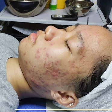 Chăm sóc da mụn