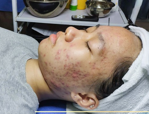 trị mụn