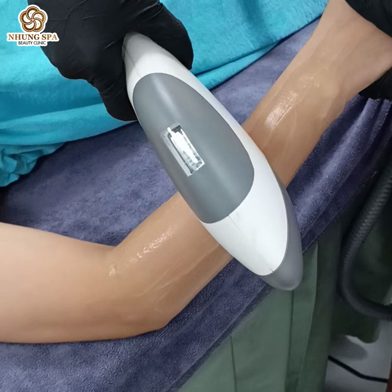 Triệt lông tay