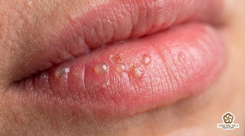 Xăm môi xong bị mụn nước